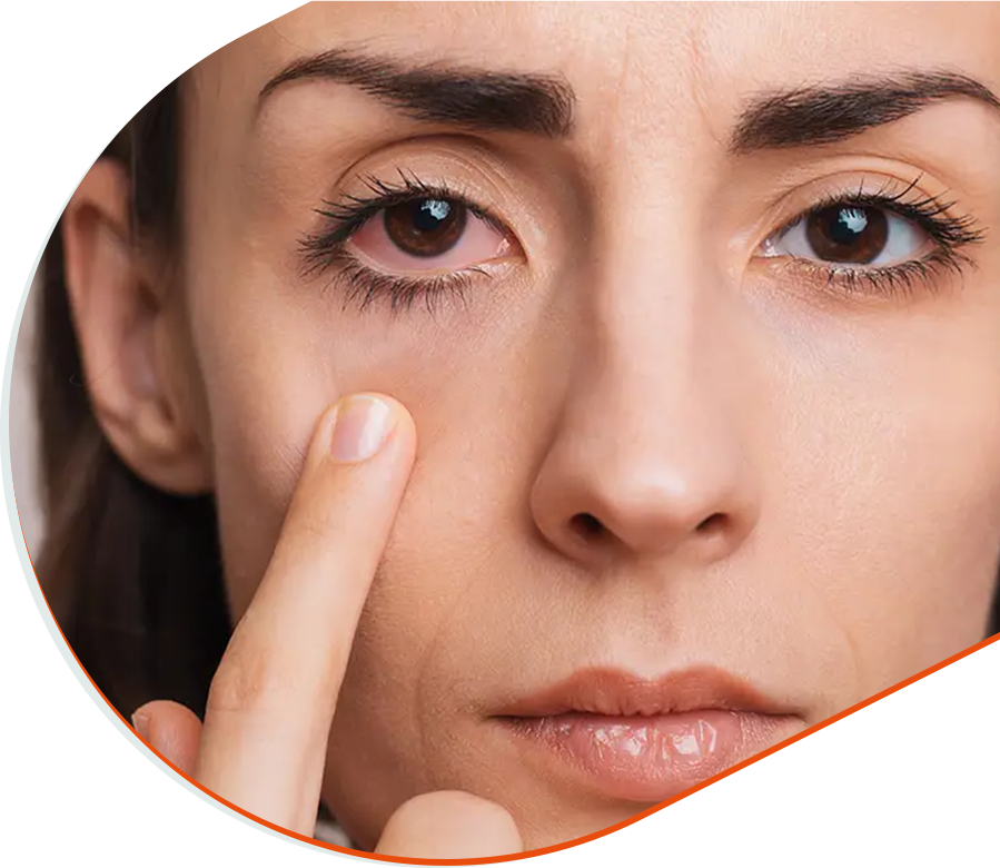 Symptôme d’œil rouge, irritation oculaire