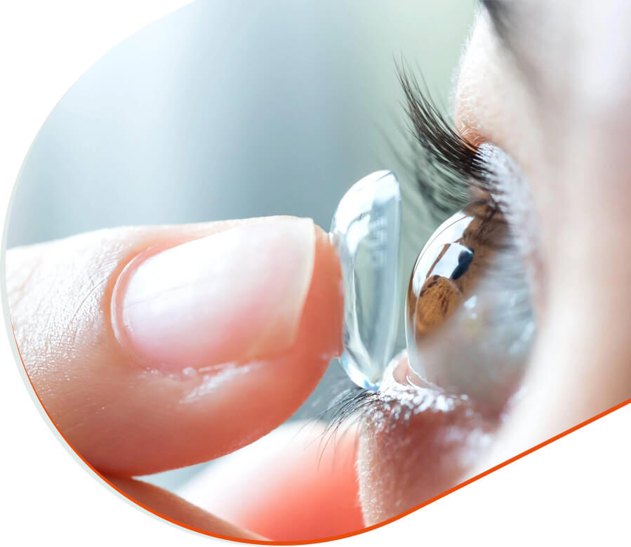 Pose d’un verre de contact sur l’œil